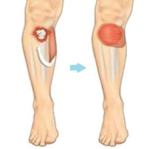 Calf muscle transferred to cover a wound at the front of the leg (source BAPRAS)