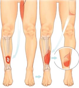 Diagram depicts a muscle taken from the thigh to cover a wound over an open fracture on the other leg; the donor site is closed directly, and the muscle flap is covered with a skin graft (source BAPRAS)