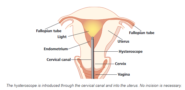 Hysteroscope in the cervical canal