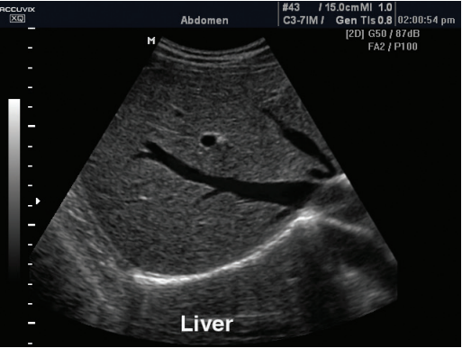 Scan of the liver. 