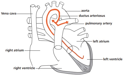 a heart with a PDA (Patent Ductus Arteriosus).