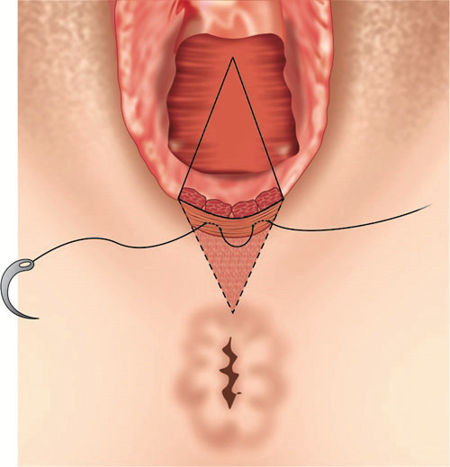 Image of perineal reconstruction