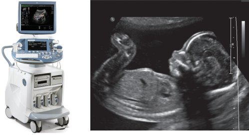 Ultrasound equipment and example of scan