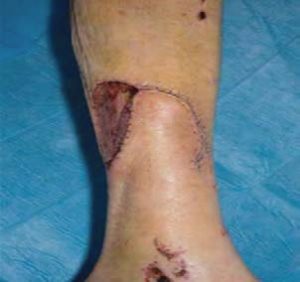 Skin and fat flap mobilised to cover wound on leg with secondary wound resurfaced with skin graft