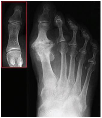 Image of hallux rigidus, before and after surgery