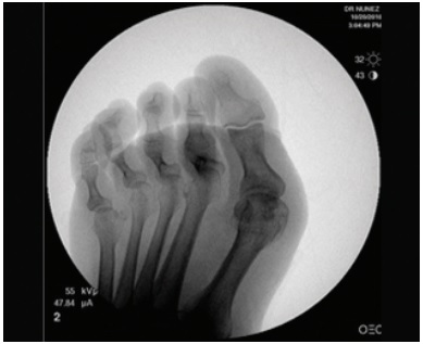 Image of Hammer and mallet toe x-ray before operation